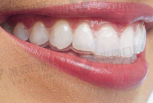 什么是附着体义齿（*密附着体栓道义齿图片）(图1)
